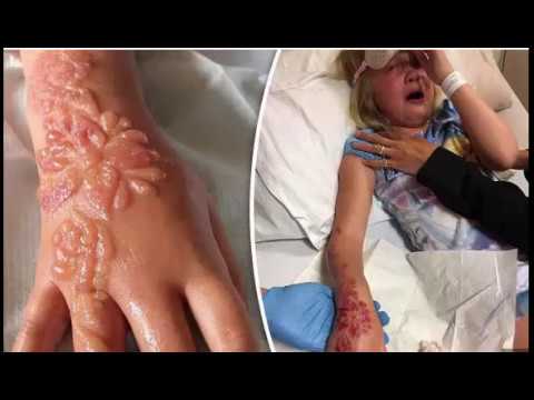 Horrific Burns After Getting Henna Tattoo in Egypt
