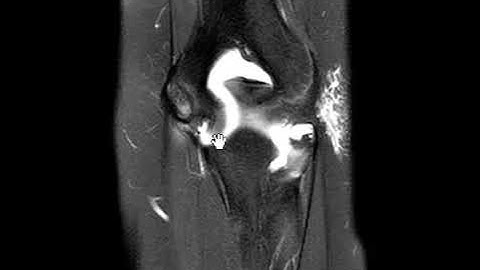 UCL tear from humeral attachment in young pitcher
