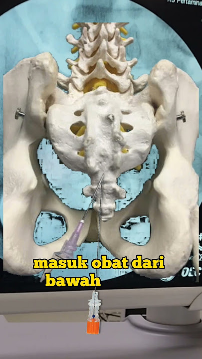 Kapan Saraf Kejepit Pinggang Perlu Injeksi Intervensi Nyeri?