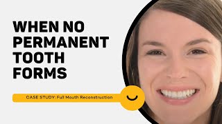 Congenitally Missing Front Teeth - Before and After