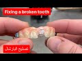 Repairing a cast metal partial denture