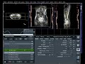 How to MRI of Enterography Planning..