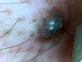ほくろの毛を引っこ抜く！part4 Hair of a mole!