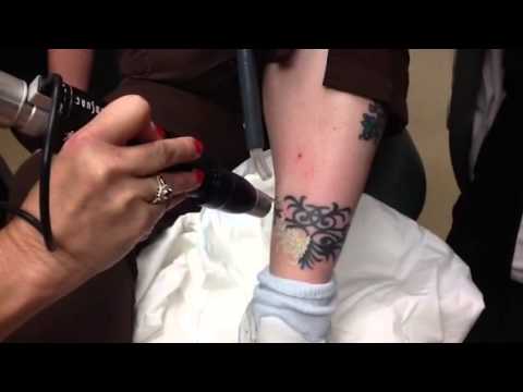 Picosure Tattoo Removal - YouTube