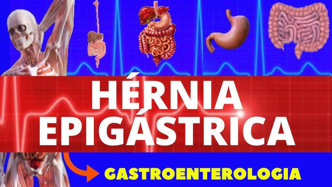 Cinco dicas para a recuperação da cirurgia de hérnia epigástrica - SBH