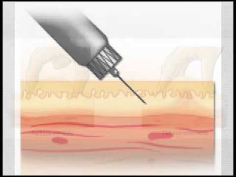 Técnica de aplicación de insulina. - YouTube Técnica de aplicación de insulina. - YouTube