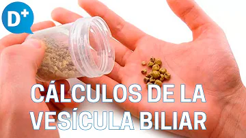 ¿Pueden los cálculos biliares provocar malestar general?