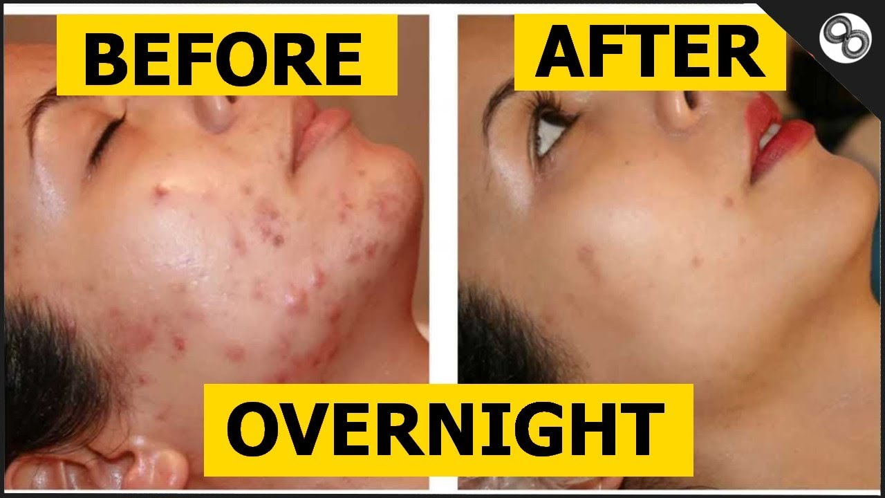 Remove Pimple Or Dark Spot In 1 Day Scientific Remedy Youtube remove pimple or dark spot in 1 day scientific remedy