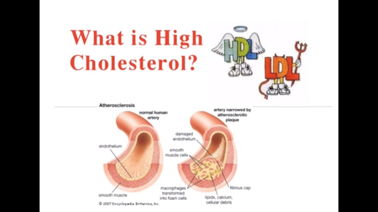 How To Affect Your Cholesterol With Weight Loss YouTube how-to-affect-your-cholesterol-with-weight-loss-youtube