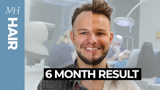 Hair Transplant Results | 6 Months Before and After