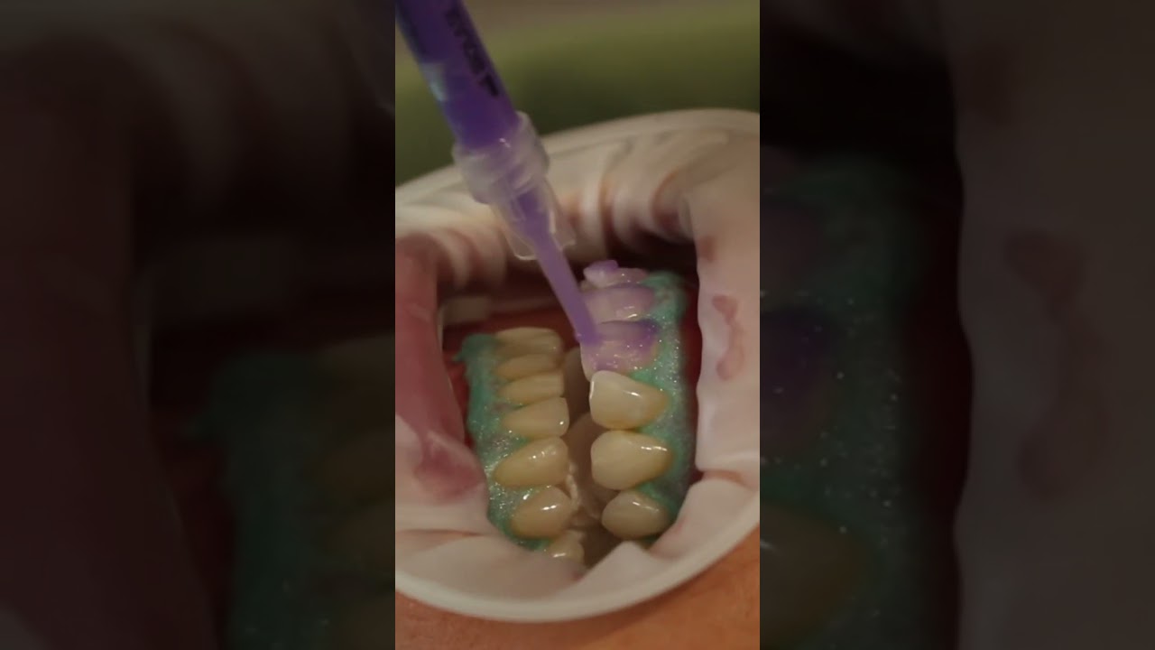 Laser teeth whitening