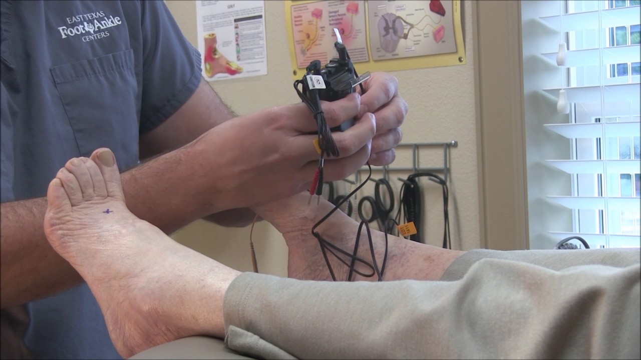 Plantar Fasciitis Relief: How TENS Units Can Help