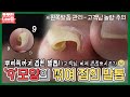9모양으로 뿌리쪽까지 꺾여 접혀있는 발톱! ※고객님 놀람 주의 ingrown toenail / ingrowing nail - Fresh Foot