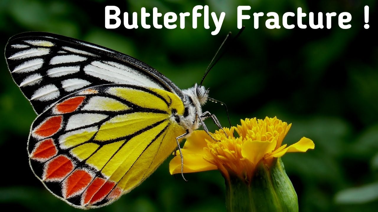 Butterfly Fracture Ortho YouTube