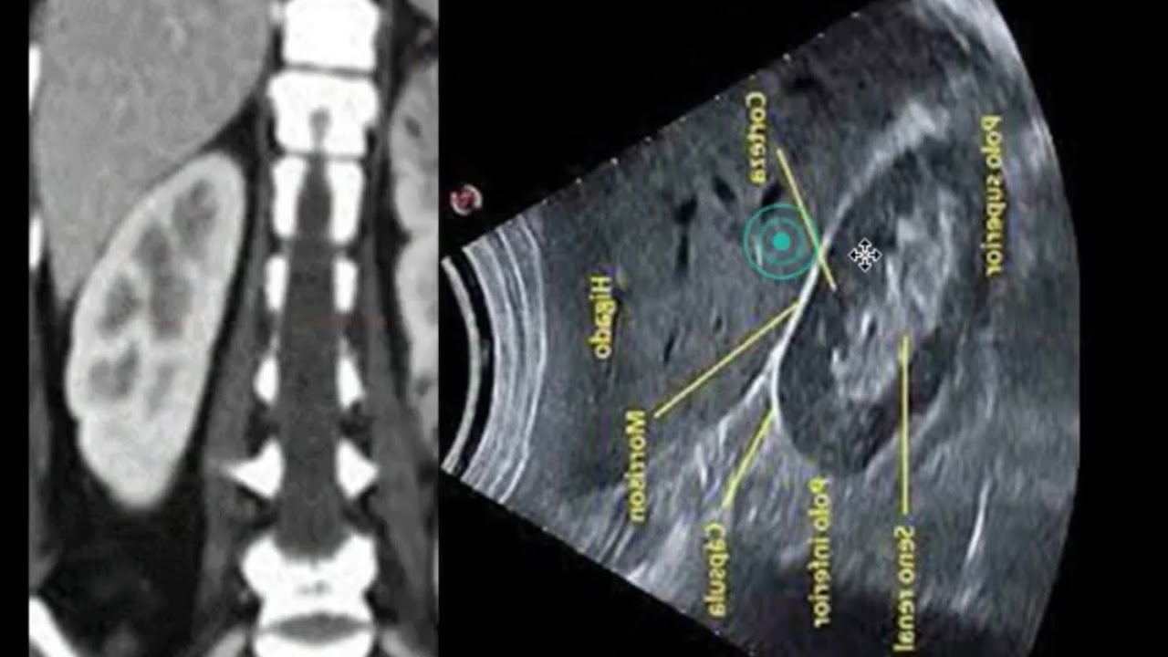 Ultrasonido de Riñones lo básico