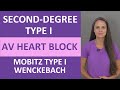 Understanding Second Degree Type One Heart Blocks