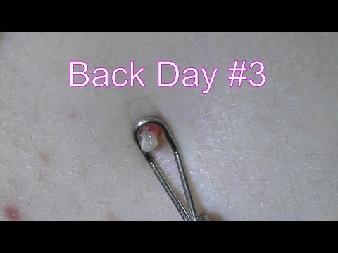 Back Day# ft. My Lovely Assistant | Life With Cystic Acne Documentary #