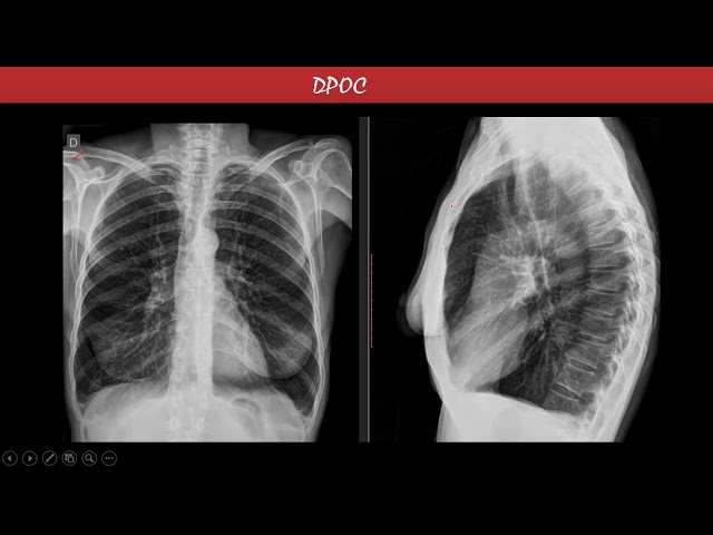 radiografia-de-torax-com-enfisema-1638x2048