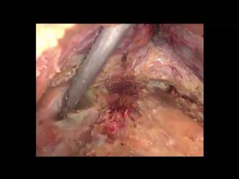 Laparoscopic Extralevator Abdominoperineal Excision For Low Rectal Cancer