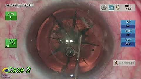 Using the FEMTO LDV Z8 to handle posterior polar Cataract by Dr. Moraru