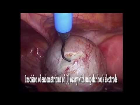 Video: Endometrioid Ovarian Cyst - Causes, Signs And Symptoms Of An Endometrioid Cyst Of The Left And Right Ovary, Laparoscopy