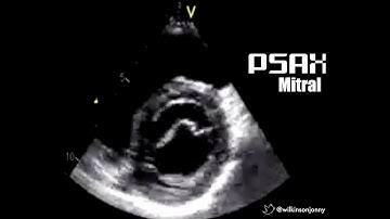 Parasternal Short Axis Mitral Level (PSAX Mitral)
