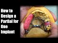 How to Design a Partial for One Implant