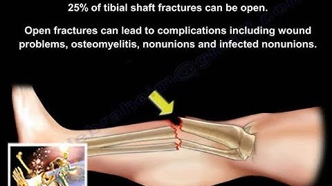 Open Fractures Of The Tibia  - Everything You Need To Know - Dr. Nabil Ebraheim