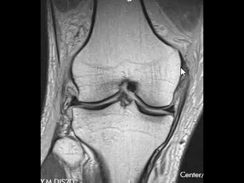 Video: Mediálna Kolaterálna Poranenie Kolena (MCL Tear)