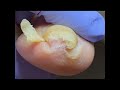 Curly, yellowed toenails get a comfortable trim~ #nails #satisfying