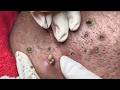 Feel The Extraction Through The Screen | Pimple Popping #800168