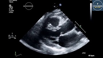Protocol Tiêu Chuẩn Khảo Sát Siêu Âm Tim Người Lớn : 2D và Color Doppler