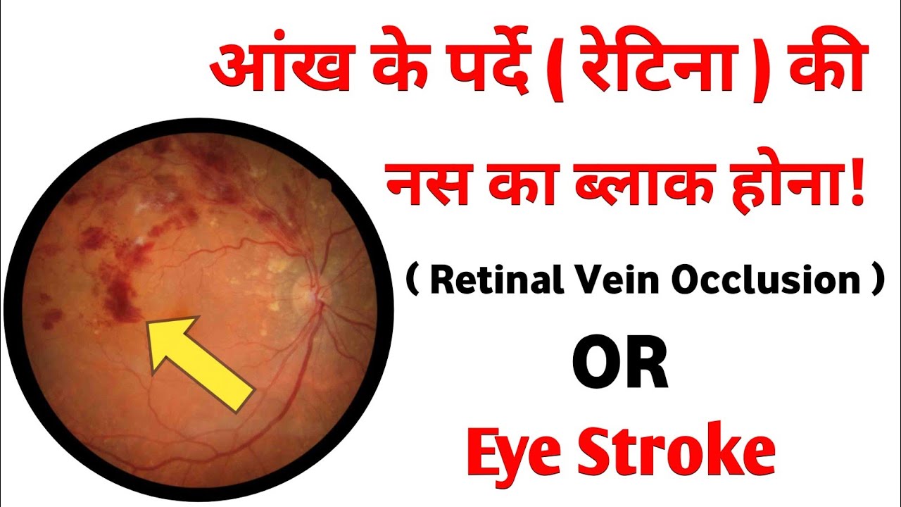 Retinal Vein Occlusion Eye Stroke Retinal vein occlusion eye stroke