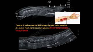Ultrasound and Doppler in slow flow vascular malformation screenshot 3