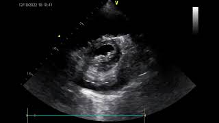 Severe Mitral Stenosis with Massive LA Thrombus | Echo
