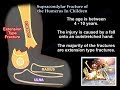 Supracondylar Fracture Of The Humerus In Children - Everything You Need To Know - Dr. Nabil Ebraheim