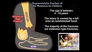 Supracondylar Fracture Of The Humerus In Children - Everything You Need To Know - Dr. Nabil Ebraheim