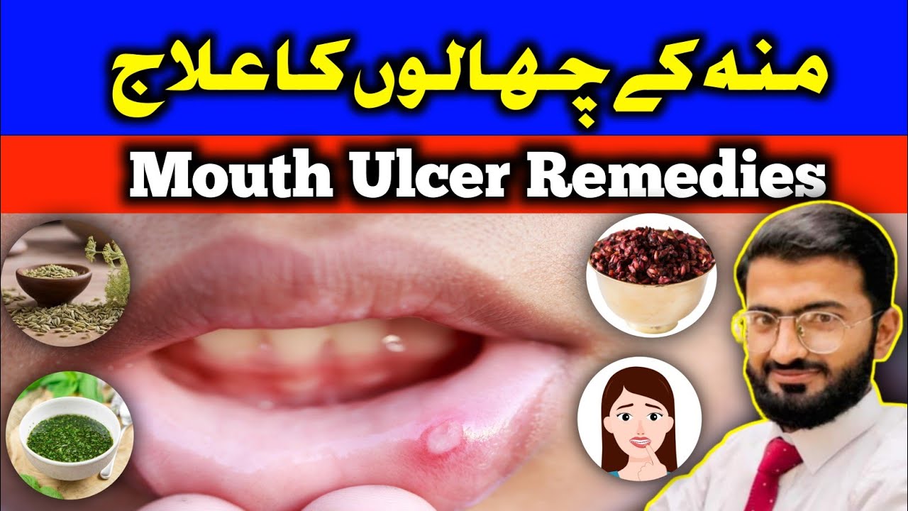 Mouth Sores:Causes & Treatment of Mouth Soreness in Urdu/Hindi|Home Remedies