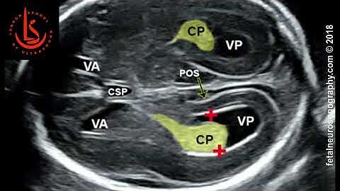 Fetal lateral ventricle measurements: How to measure posterior ventricle for ventriculomegaly