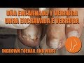 Ingrown toenail & wart - Uña encarnada y verruga [Podología Integral] #podologiaintegral