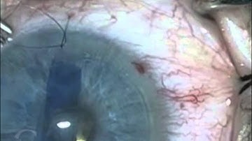 DMEK in a Pseudophakic Eye