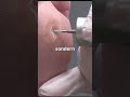 Hühnerauge mit Hohlfräser