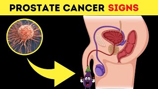 Prostate Cancer Signs, Symptoms and Treatment