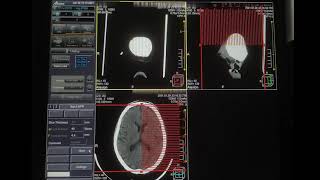 Tomografia do crânio #video03 screenshot 2