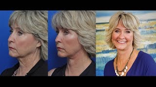 Susan's Facelift Transformation Story