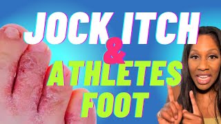 Jock Itch &amp; Athlete’s Foot: Causes, Prevention and Treatment. A Doctor Explains