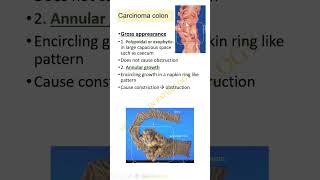Shorts-Colonic cancer -II. Dr GSS SRM MCH RC. SUBSCRIBE!!