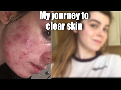 What happened to my acne when I quit washing my face for a month