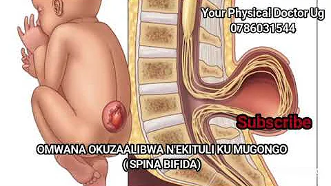 OMWANA OKUZAALIBWA N'EKITULI KU MUGONGO. ( SPINA BIFIDA)