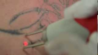 Tattoo Removal Laser Ink Undone Melbourne Mr B